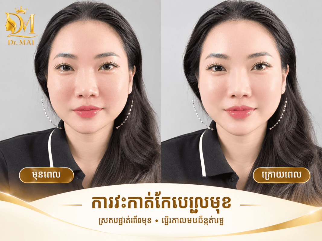 រូបភាពមុន និងក្រោយពេលចាក់ Botox