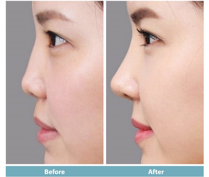 rhinoplasty, before-after Dr Mai