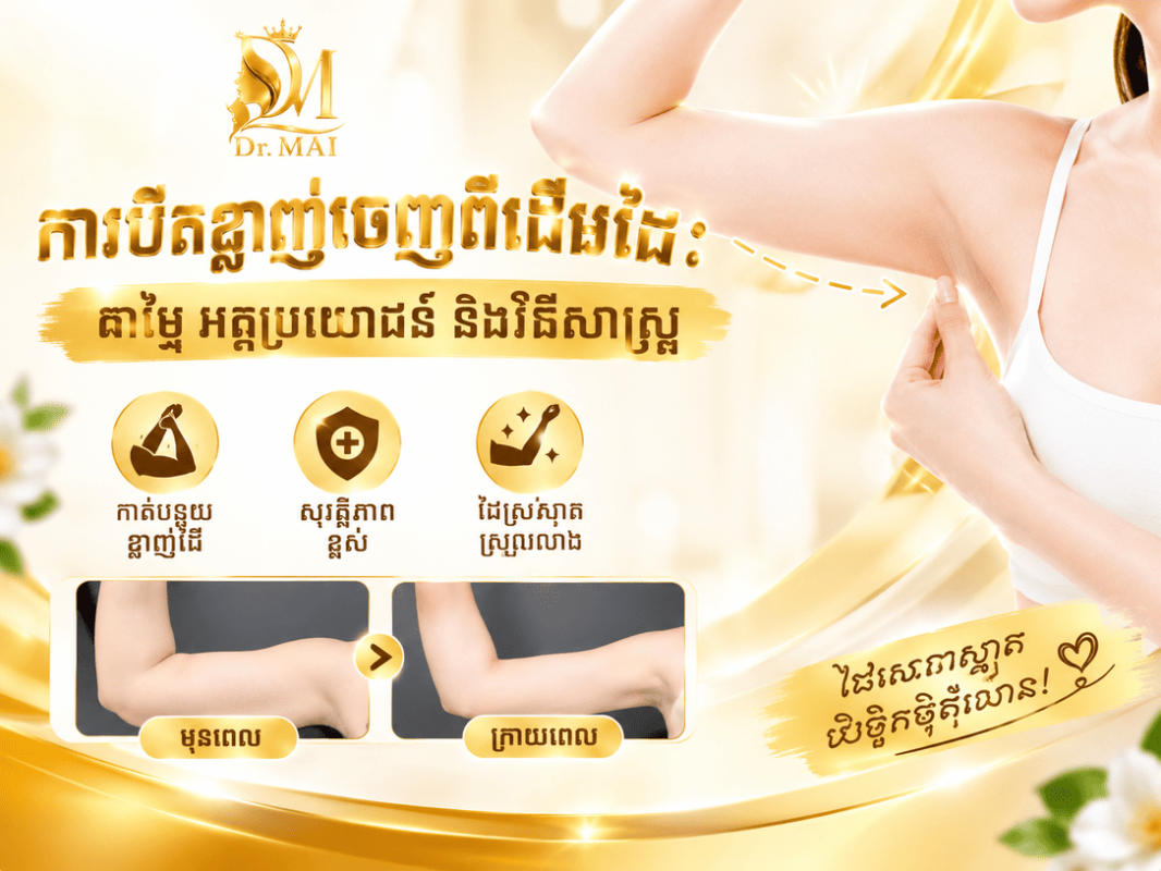 ការបឺតខ្លាញ់ចេញពីដើមដៃ