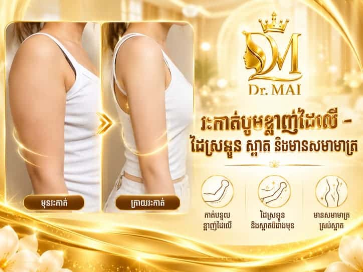 វះកាត់បូមខ្លាញ់ដៃលើ